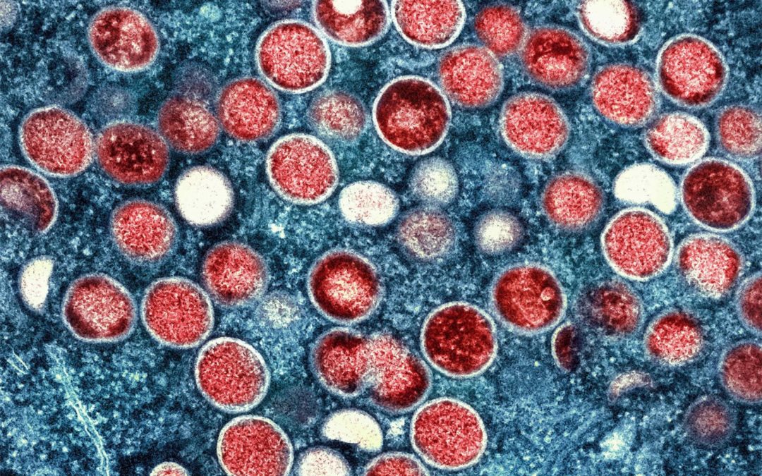 Affenpocken-Impfstoff in Deutschland und Europa teils knapp